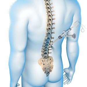 Endoscopic Spine Surgery In Greater Noida 