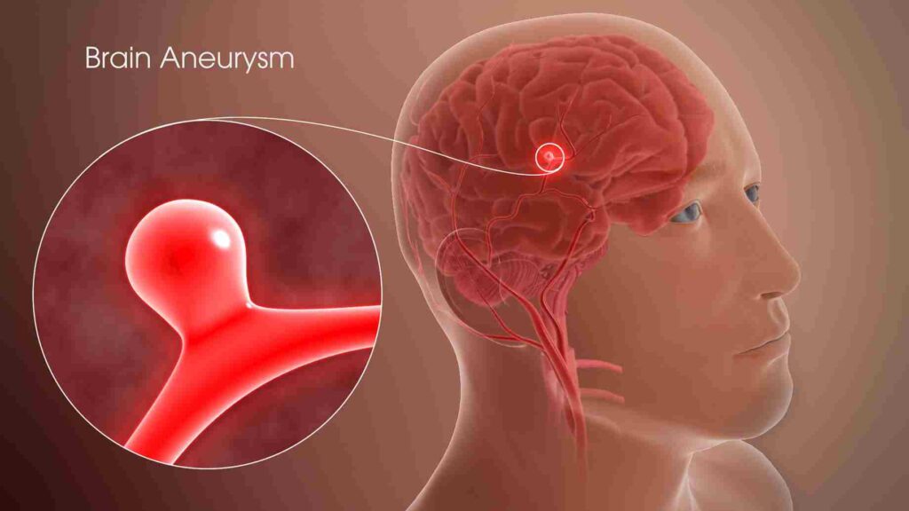 Brain Aneurysms Treatment by Dr Prashant Agarwal