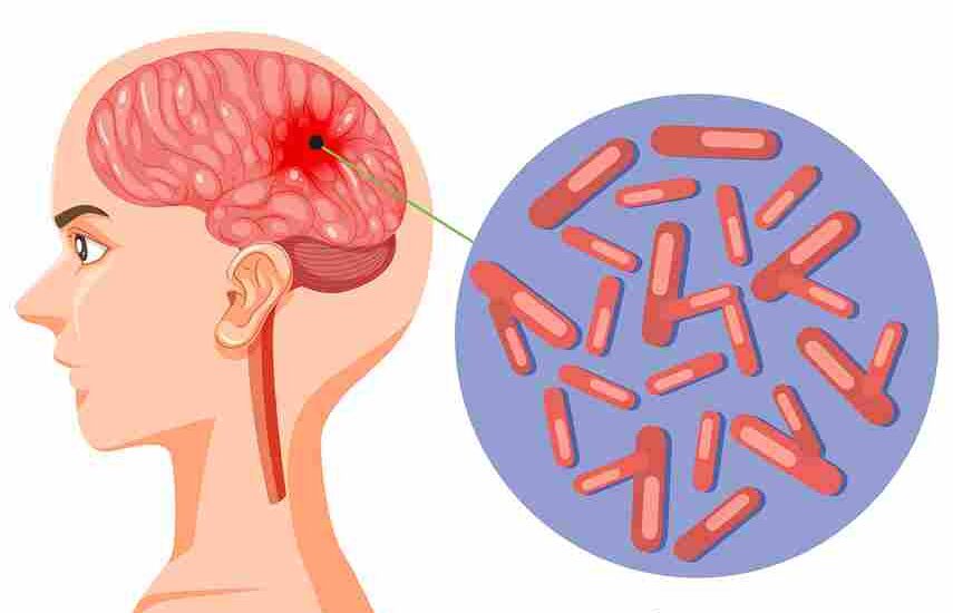 Everything About Meningitis And Neck Pain