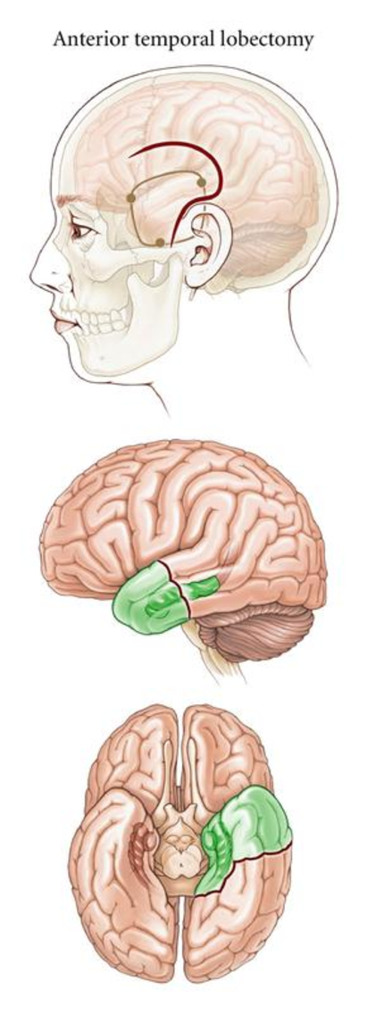 The Role of Neurosurgery in Epilepsy Surgery Management and Seizure Control