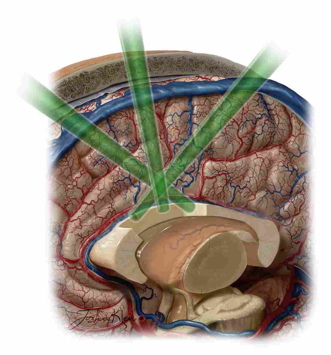 The Role of Neurosurgery in Epilepsy Surgery Management and Seizure Control