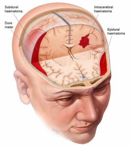 Root Cause of Traumatic Brain Injuries