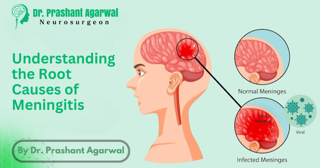 Root Causes of Meningitis