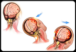 Root Cause of Traumatic Brain Injuries