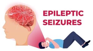 Seizure Specialist in Greater Noida