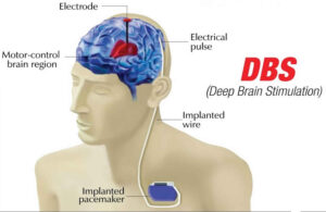 Deep Brain Stimulation