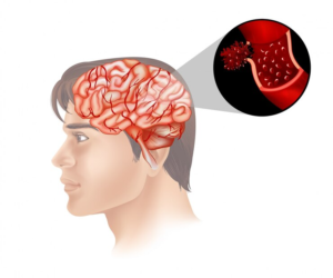Best Brain stroke specialist in Greater Noida