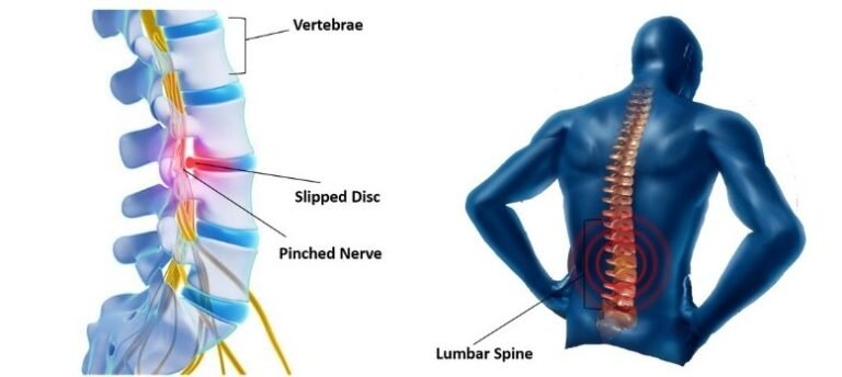 Slipped Disk Rash Best Slip Disc Treatment in Greater Noida | +91 8920248282