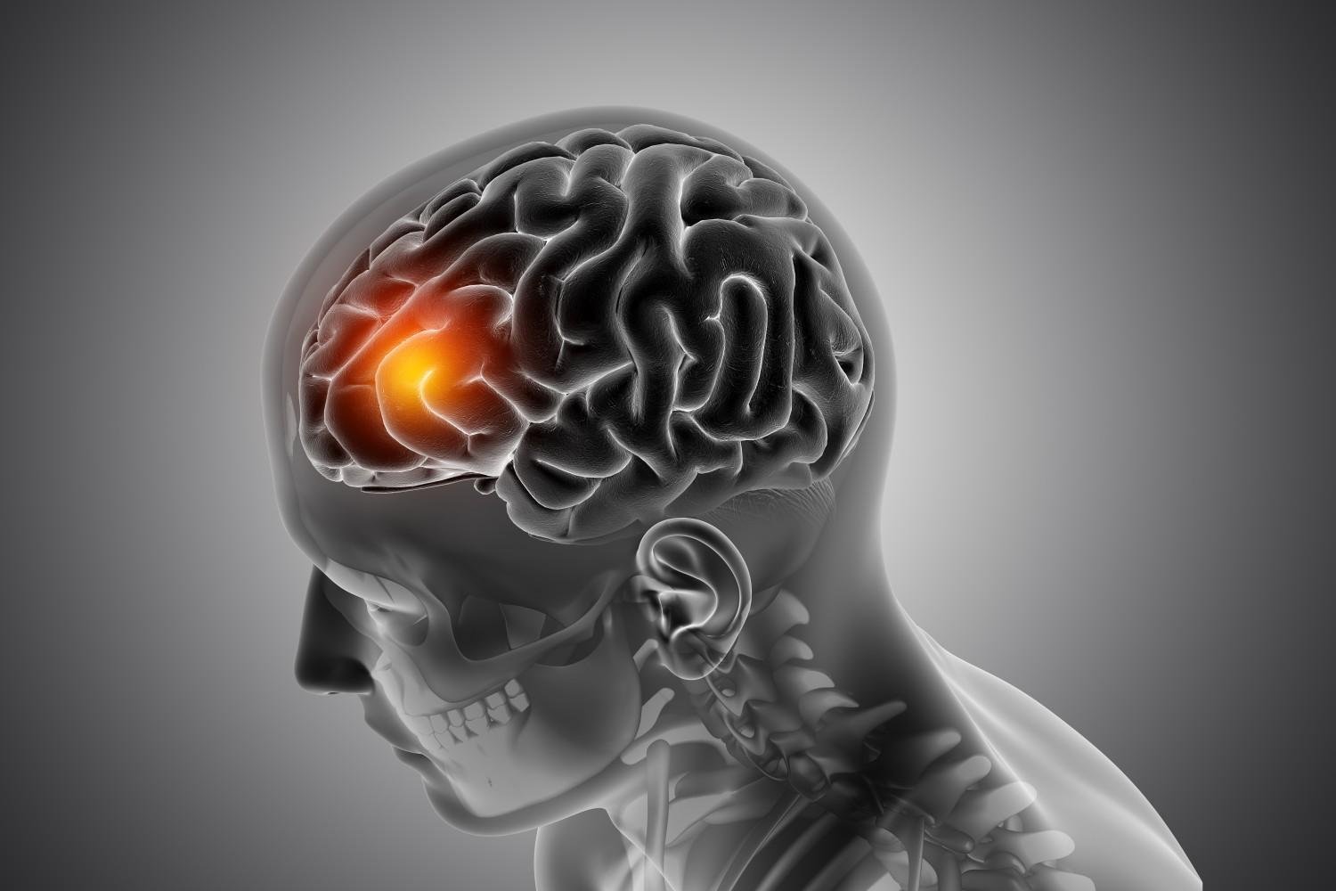 Brain Tumor Treatment in Noida