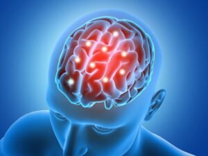 Brain Hemorrhage Treatment in Noida